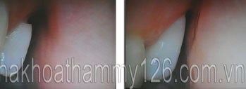http://nhakhoa126.com/hinhanh/Benh-ly/nha-khoa-126-mon-co-chan-rang07.jpg