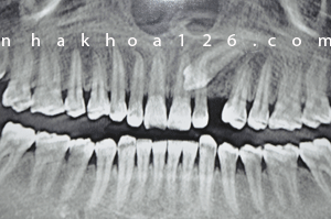 http://nhakhoa126.com/hinhanh/Benh-ly/nha-khoa-126-rang-nanh-ngam-xquangtoanham.gif