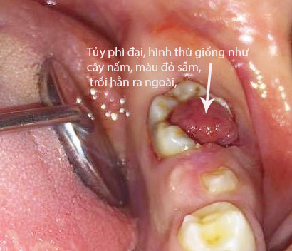 http://nhakhoa126.com/hinhanh/Benh-ly/nha-khoa-ba-lan-viem-tuy-phi-dai.jpg