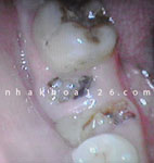 http://nhakhoa126.com/hinhanh/Benh-ly/nha-khoa-rang-sau03.jpg