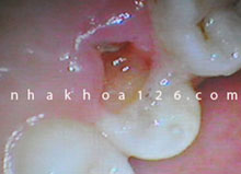 http://nhakhoa126.com/hinhanh/Benh-ly/nha-khoa-rang-sau06.jpg