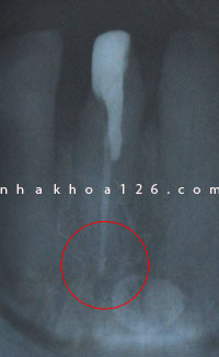 http://nhakhoa126.com/hinhanh/Benh-ly/nhakhoa126-rang-bi-thung-chop-tuy.jpg
