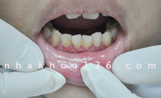 http://nhakhoa126.com/hinhanh/Benh-ly/voirang-viemnuou.jpg