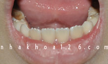 Vàng răng ở trẻ: nguyên nhân và cách phòng tránh